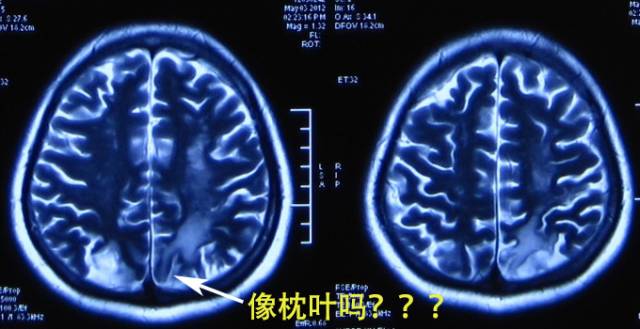 从解剖到影像,看透顶叶 从解剖到影像,看透顶叶
