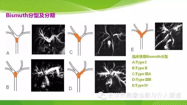 【PPT】肝门部胆管癌的影像诊断与介入治疗