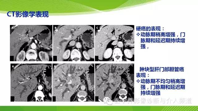 【PPT】肝门部胆管癌的影像诊断与介入治疗