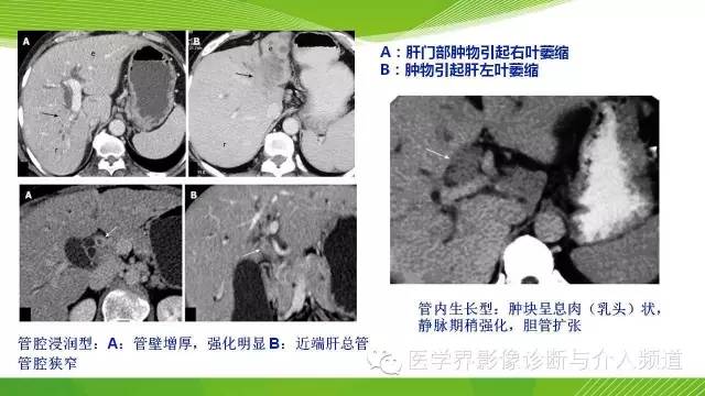 【PPT】肝门部胆管癌的影像诊断与介入治疗