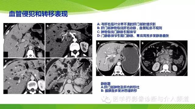 【PPT】肝门部胆管癌的影像诊断与介入治疗