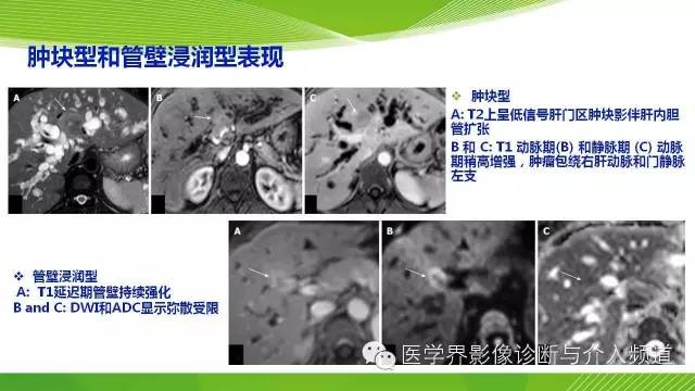 【PPT】肝门部胆管癌的影像诊断与介入治疗