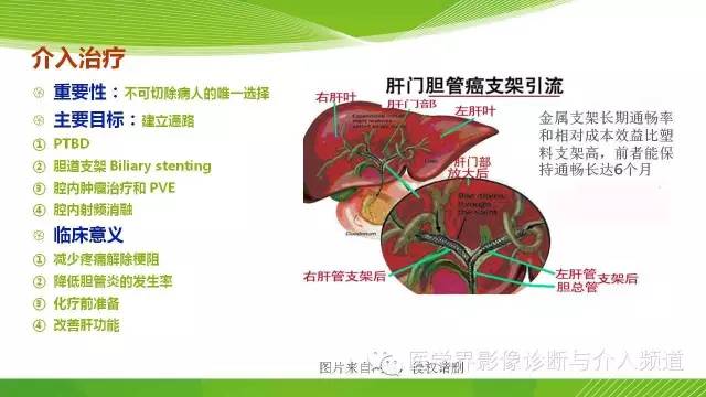 【PPT】肝门部胆管癌的影像诊断与介入治疗