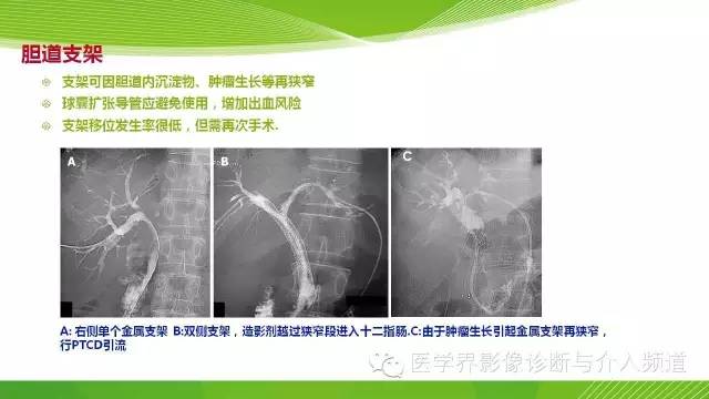 【PPT】肝门部胆管癌的影像诊断与介入治疗