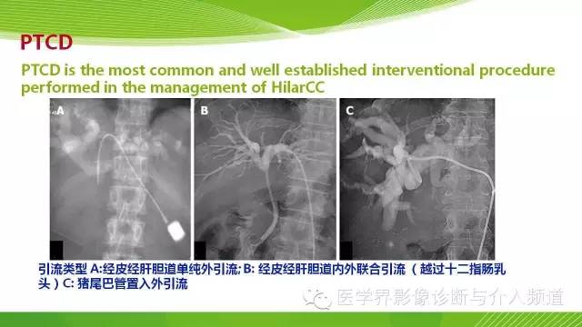 【PPT】肝门部胆管癌的影像诊断与介入治疗