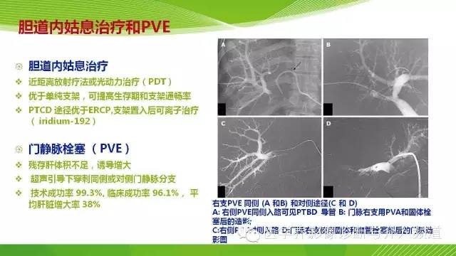 【PPT】肝门部胆管癌的影像诊断与介入治疗