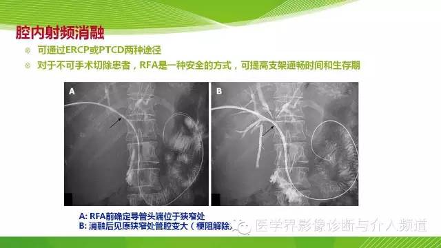 【PPT】肝门部胆管癌的影像诊断与介入治疗
