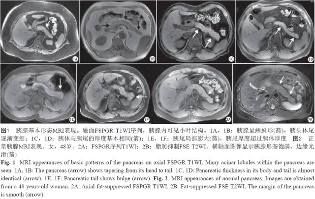 胰腺解剖变异和脂肪沉积的MR影像表现
