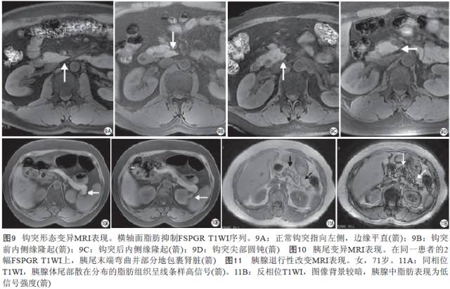 胰腺解剖变异和脂肪沉积的MR影像表现 胰腺解剖变异和脂肪沉积的MR影像表现