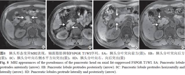 胰腺解剖变异和脂肪沉积的MR影像表现 胰腺解剖变异和脂肪沉积的MR影像表现