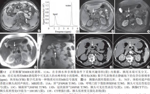 胰腺解剖变异和脂肪沉积的MR影像表现 胰腺解剖变异和脂肪沉积的MR影像表现