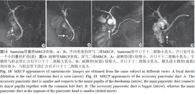 胰腺解剖变异和脂肪沉积的MR影像表现 胰腺解剖变异和脂肪沉积的MR影像表现