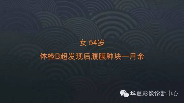 【病例】腹膜后节细胞神经瘤1例CT影像表现