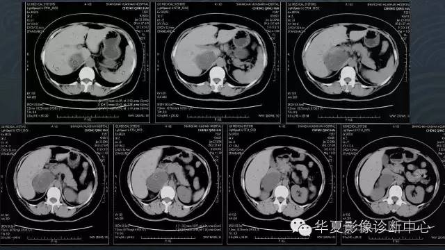 【病例】腹膜后节细胞神经瘤1例CT影像表现