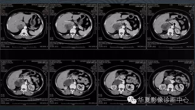 【病例】腹膜后节细胞神经瘤1例CT影像表现