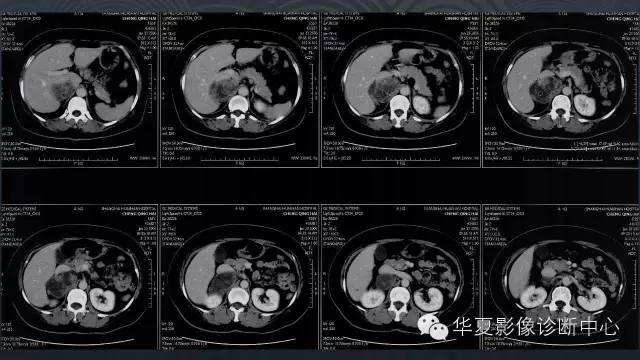 【病例】腹膜后节细胞神经瘤1例CT影像表现