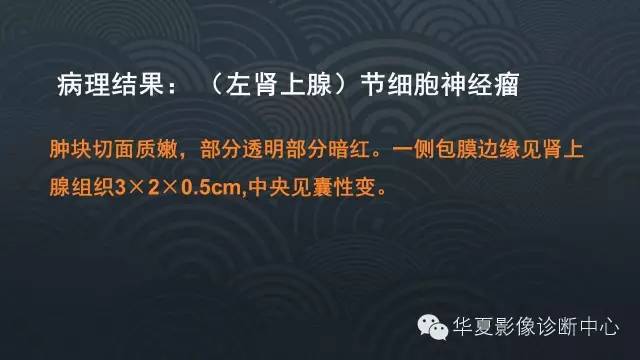 【病例】腹膜后节细胞神经瘤1例CT影像表现
