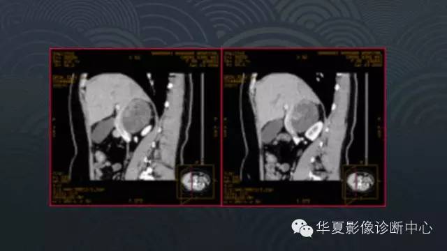 【病例】腹膜后节细胞神经瘤1例CT影像表现