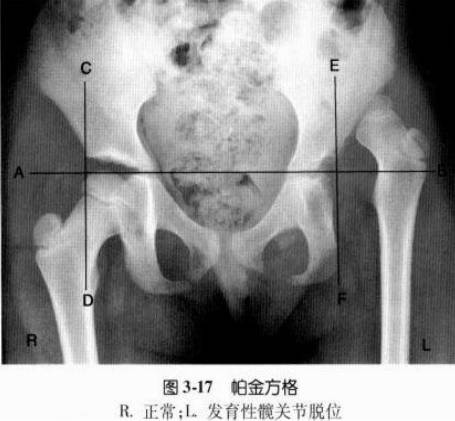 髋关节X线评估和测量方法大汇总