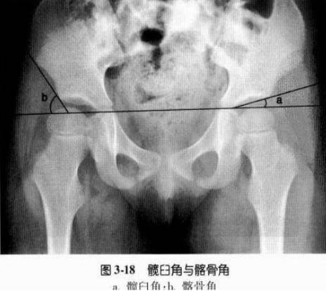 髋关节X线评估和测量方法大汇总