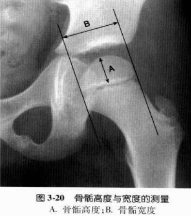髋关节X线评估和测量方法大汇总