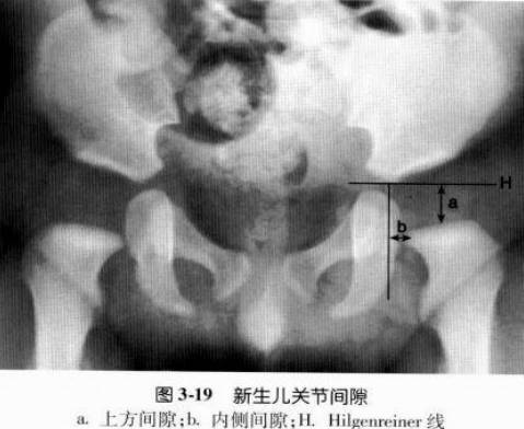 髋关节X线评估和测量方法大汇总