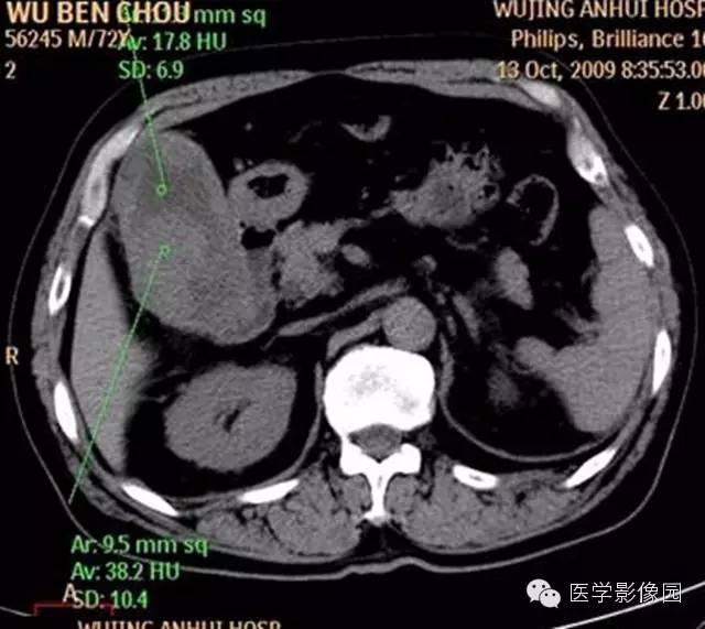 【病例】肺部炎性肌纤维母细胞瘤1例CT影像表现 【病例】肺部炎性肌纤维母细胞瘤1例CT影像表现