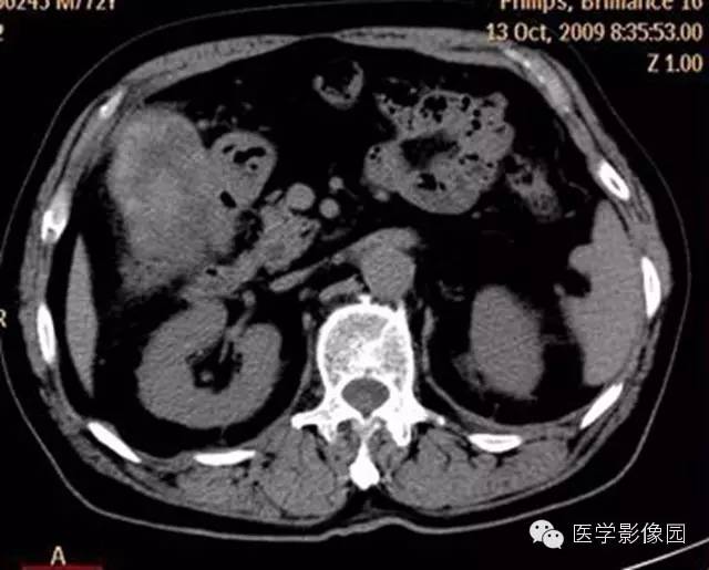 【病例】肺部炎性肌纤维母细胞瘤1例CT影像表现 【病例】肺部炎性肌纤维母细胞瘤1例CT影像表现