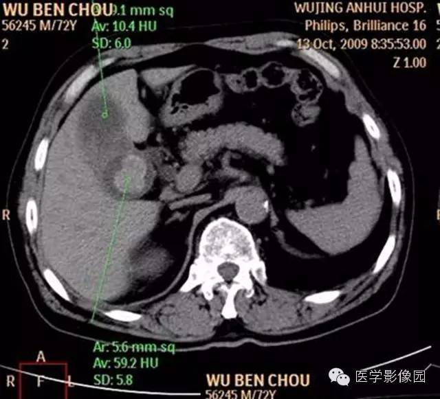 【病例】肺部炎性肌纤维母细胞瘤1例CT影像表现