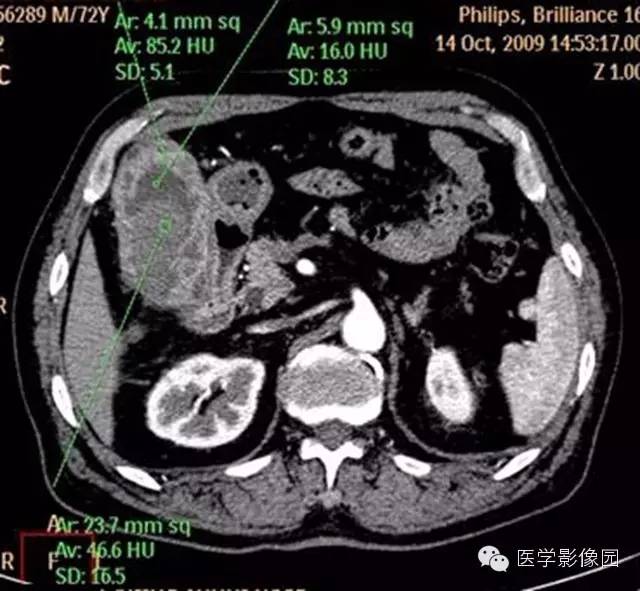 【病例】肺部炎性肌纤维母细胞瘤1例CT影像表现 【病例】肺部炎性肌纤维母细胞瘤1例CT影像表现