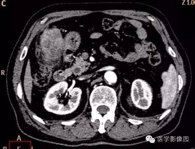 【病例】肺部炎性肌纤维母细胞瘤1例CT影像表现 【病例】肺部炎性肌纤维母细胞瘤1例CT影像表现