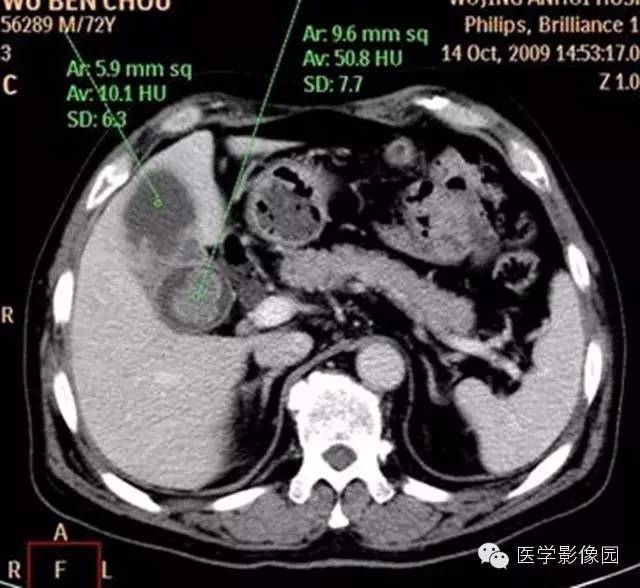 【病例】肺部炎性肌纤维母细胞瘤1例CT影像表现 【病例】肺部炎性肌纤维母细胞瘤1例CT影像表现
