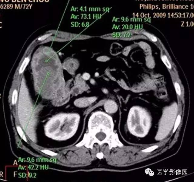 【病例】肺部炎性肌纤维母细胞瘤1例CT影像表现 【病例】肺部炎性肌纤维母细胞瘤1例CT影像表现