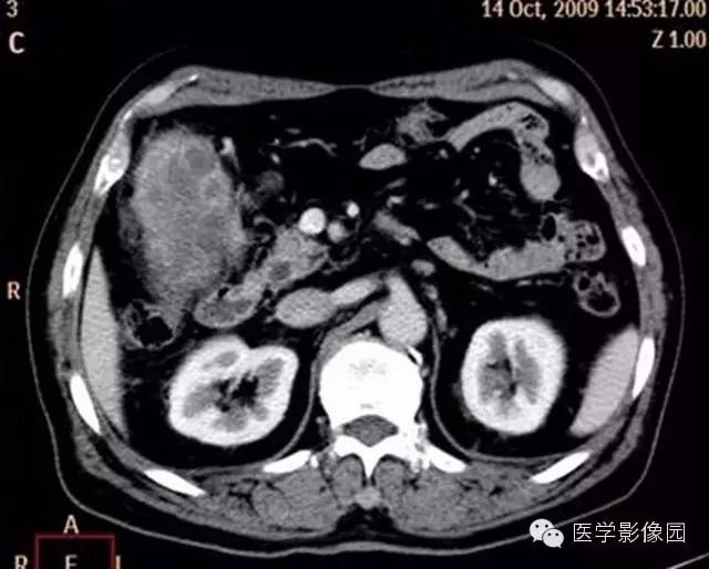 【病例】肺部炎性肌纤维母细胞瘤1例CT影像表现 【病例】肺部炎性肌纤维母细胞瘤1例CT影像表现