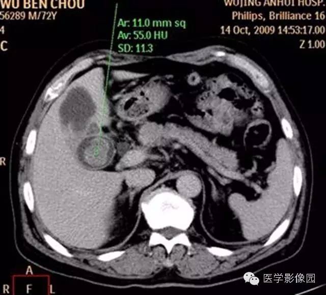【病例】肺部炎性肌纤维母细胞瘤1例CT影像表现 【病例】肺部炎性肌纤维母细胞瘤1例CT影像表现