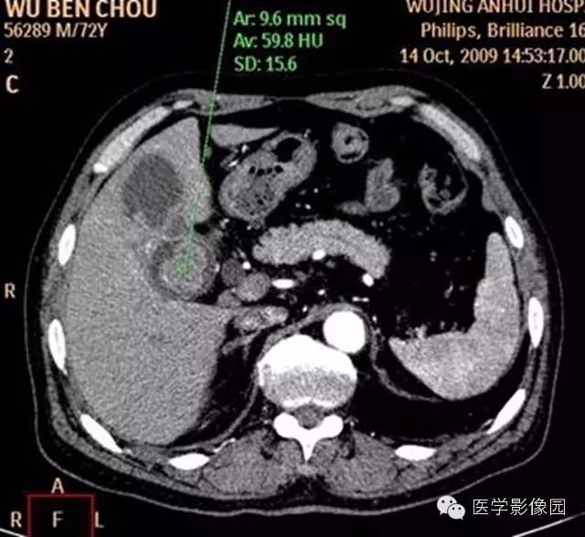 【病例】肺部炎性肌纤维母细胞瘤1例CT影像表现 【病例】肺部炎性肌纤维母细胞瘤1例CT影像表现
