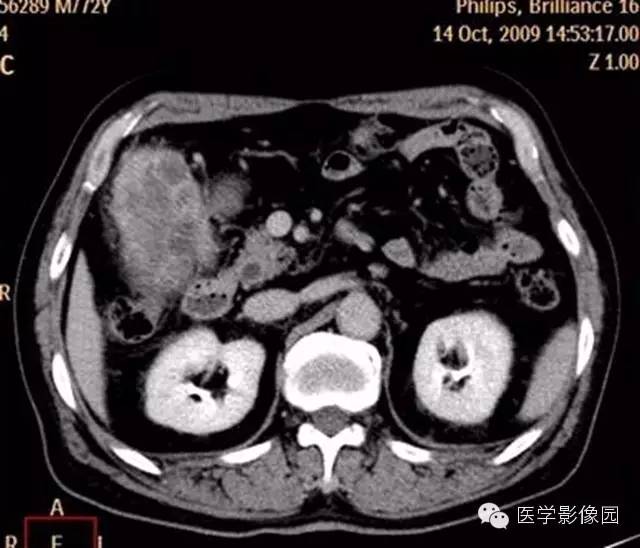 【病例】肺部炎性肌纤维母细胞瘤1例CT影像表现 【病例】肺部炎性肌纤维母细胞瘤1例CT影像表现