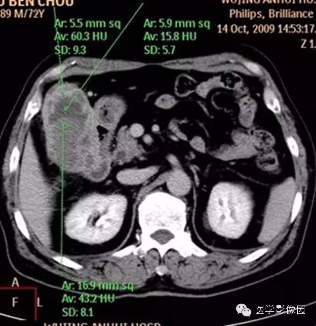 【病例】肺部炎性肌纤维母细胞瘤1例CT影像表现 【病例】肺部炎性肌纤维母细胞瘤1例CT影像表现