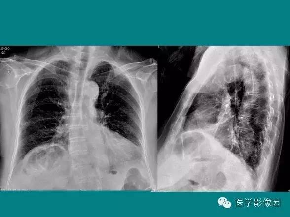 【PPT】基拉迪蒂综合征