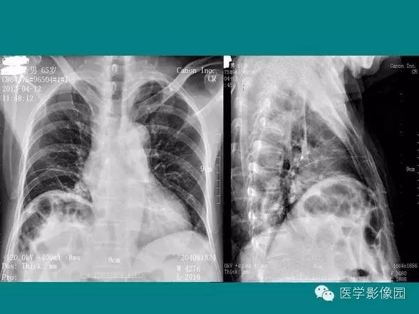 【PPT】基拉迪蒂综合征