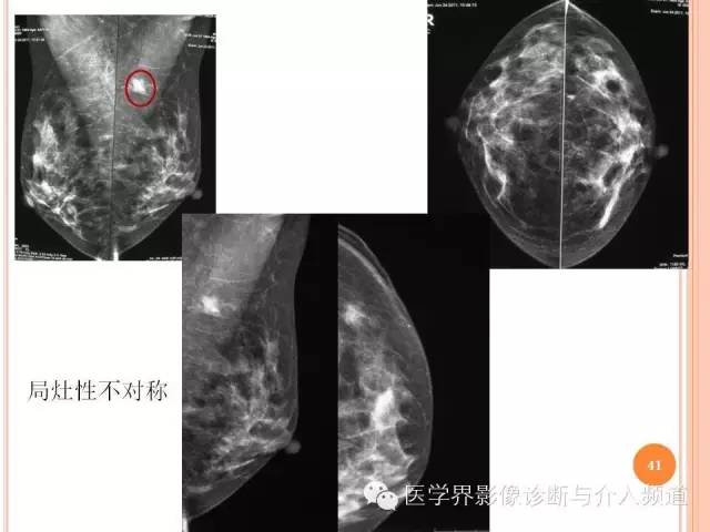 【PPT】乳腺癌的X线表现及鉴别诊断