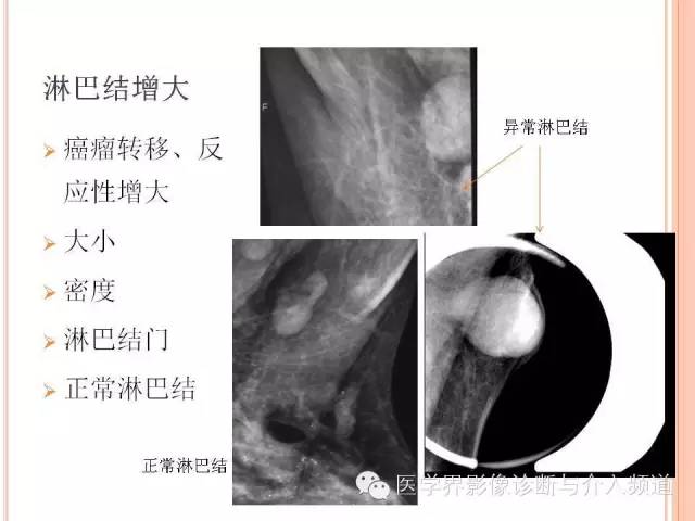【PPT】乳腺癌的X线表现及鉴别诊断