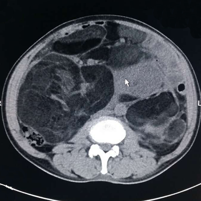 【病例】腹腔脂肪肉瘤1例CT影像表现