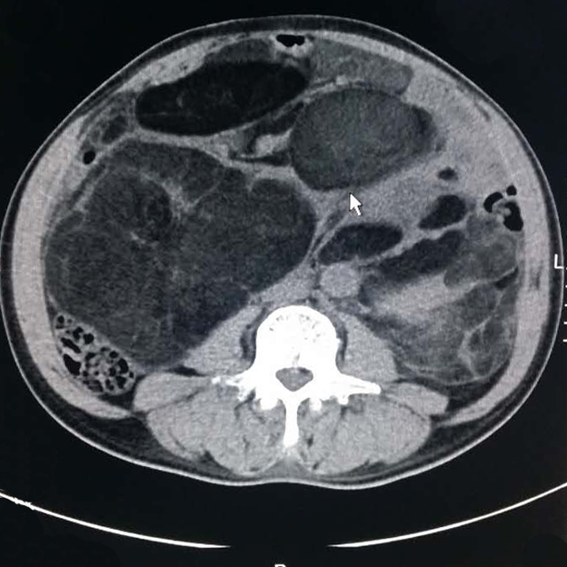 【病例】腹腔脂肪肉瘤1例CT影像表现 【病例】腹腔脂肪肉瘤1例CT影像表现