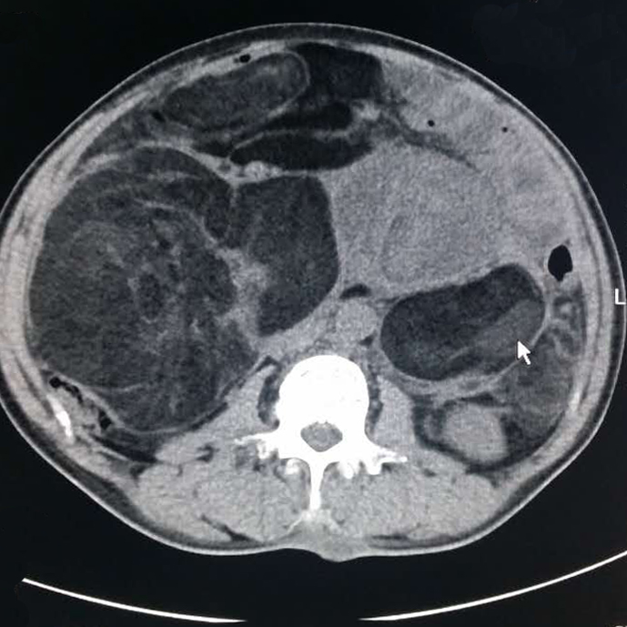 【病例】腹腔脂肪肉瘤1例CT影像表现 【病例】腹腔脂肪肉瘤1例CT影像表现