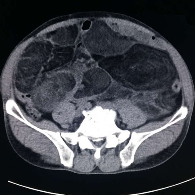 【病例】腹腔脂肪肉瘤1例CT影像表现 【病例】腹腔脂肪肉瘤1例CT影像表现