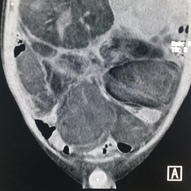 【病例】腹腔脂肪肉瘤1例CT影像表现 【病例】腹腔脂肪肉瘤1例CT影像表现