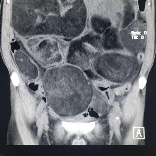【病例】腹腔脂肪肉瘤1例CT影像表现 【病例】腹腔脂肪肉瘤1例CT影像表现