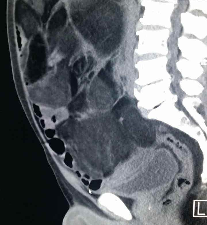 【病例】腹腔脂肪肉瘤1例CT影像表现 【病例】腹腔脂肪肉瘤1例CT影像表现