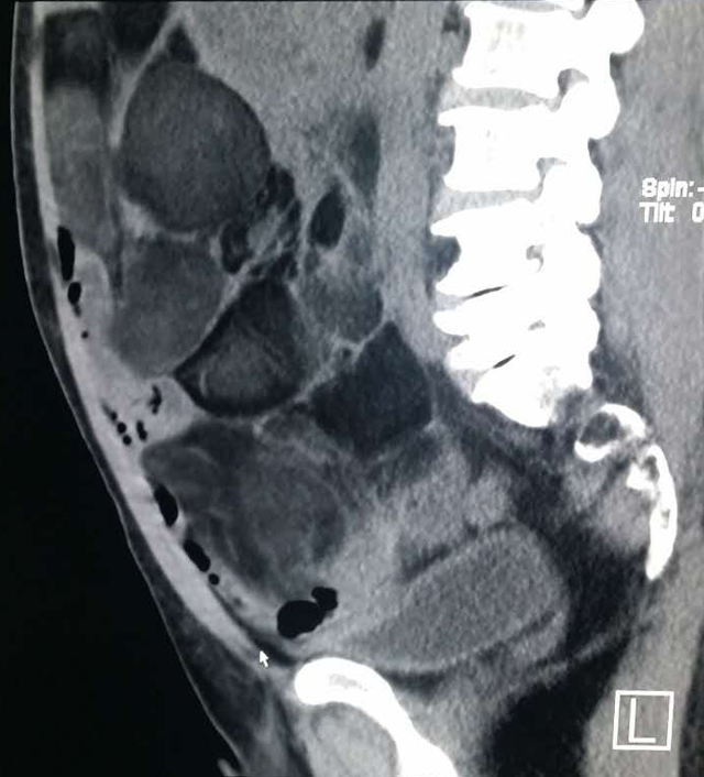 【病例】腹腔脂肪肉瘤1例CT影像表现 【病例】腹腔脂肪肉瘤1例CT影像表现